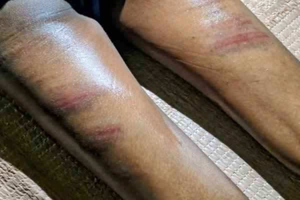 Hazaribagh: Teacher's wrath for not completing homework, fourth-grade student injured after being beaten with a stick; case reaches police station