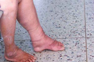 Early stages of filariasis